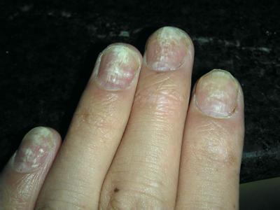 灰指甲前期症状都有哪些